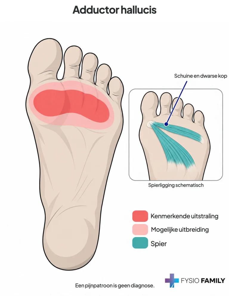 Adductor hallucis: gedeeld pijngebied onder de eerste tot vierde middenvoetskopjes. De inzet toont de ligging van de schuine en dwarse kop; omliggende pezen en botten zijn weggelaten.
