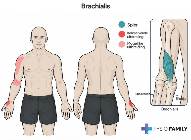 Brachialis: beschreven pijnverwijzing vanuit de bovenarm naar de duimbasis. De anatomische inzet toont de aanhechting op de ellepijp; rood en lichtrood geven het kenmerkende gebied en mogelijke uitbreiding weer.