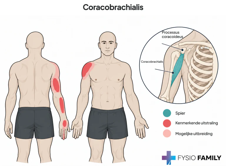 Figure 29.2. Pain pattern (red) referred from a trigger point (TrP) in the right coracobrachialis muscle. TrPs are likely to be found as far distally as the middle of the muscle belly. In patients with milder involvement, the pain may extend only to the elbow.