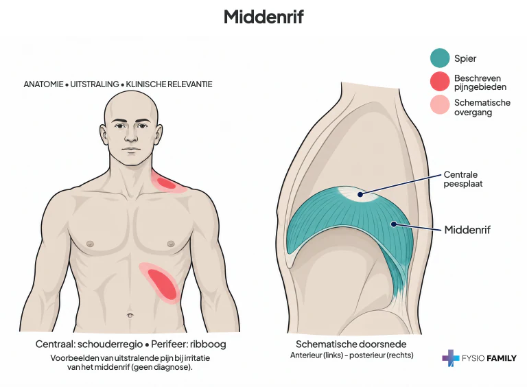 Figure 45.9. A. Examples of referred pain patterns (dark red) of TrPs in intercostal muscles (light red). A TrP can occur in any intercostal muscle. The more dorsally the TrP is located, the farther the pain pattern tends to extend toward the sternum. Patterns tend to follow the curvature of the ribs. B. TrPs in the central diaphragm muscle can refer pain to the upper border of the ipsilateral shoulder at the angle of the neck, and other TrPs refer to the anterolateral aspect of the lower border of the rib cage as in a “stitch in the side.”