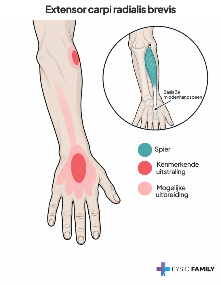 Figuur 34.3B — extensor carpi radialis brevis: vooral de handrug en dorsale pols; ook pijn rond de laterale elleboog en in de onderarm is beschreven (hoofdstuk 34, §3.1).
