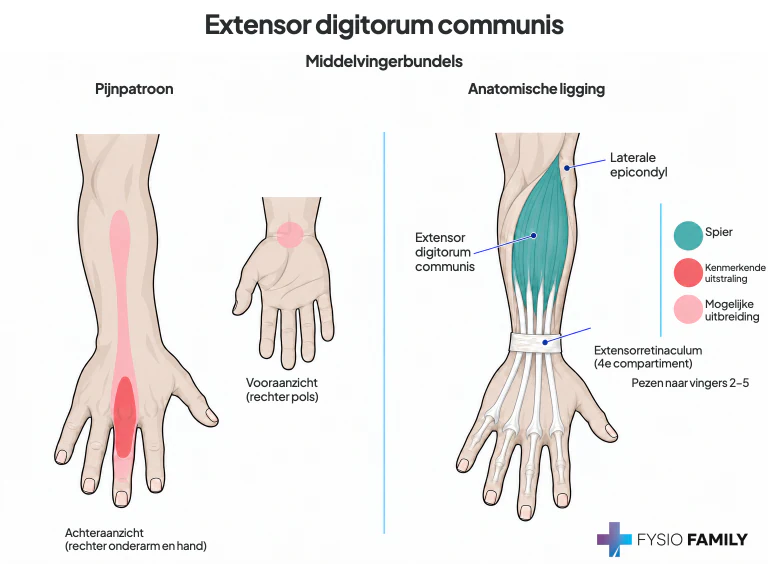 Extensor digitorum: voorbeeld vanuit de middelvingerbundel.