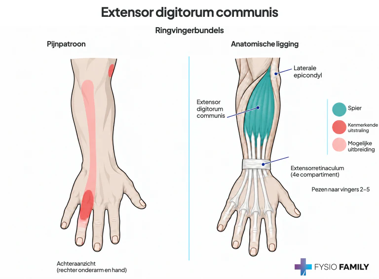 Extensor digitorum: voorbeeld vanuit de ringvingerbundel.