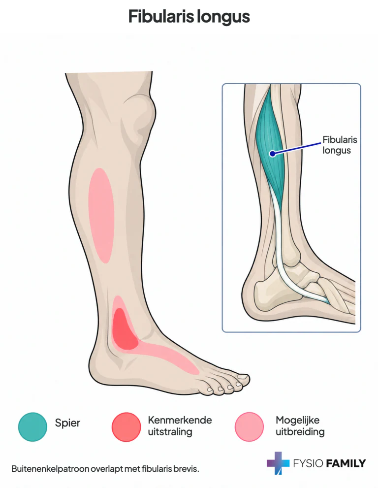 Fibularis longus: gedeeld buitenenkelpatroon en mogelijke extra uitbreiding in de buitenkuit.