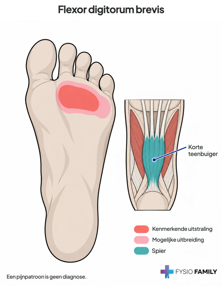 Flexor digitorum brevis: kenmerkend veld onder middenvoetskopjes 2–4, met mogelijke uitbreiding naar de vijfde straal.