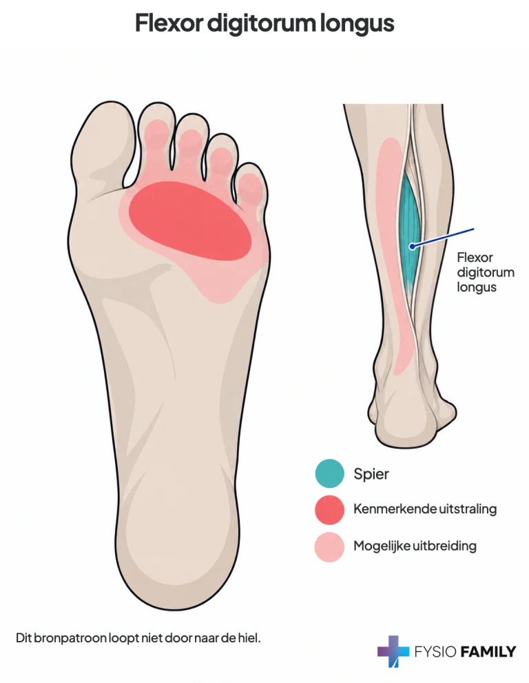 Flexor digitorum longus: onder de bal van de vier kleine tenen, met mogelijke uitbreiding naar tenen en mediale onderbeenregio.