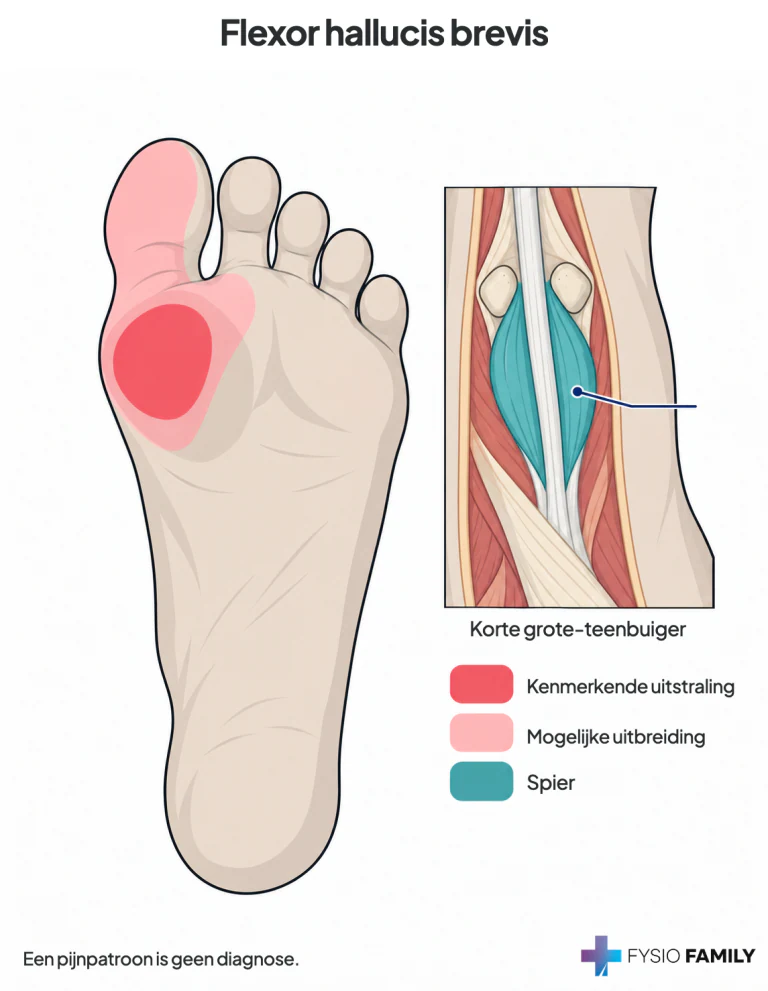 Korte grote-teenbuiger: bal onder de grote teen met mogelijke uitbreiding naar hallux en een deel van teen 2.