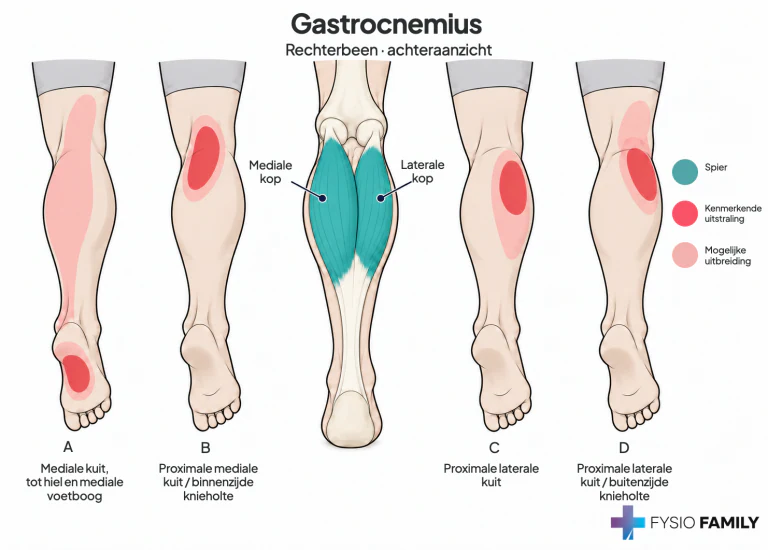 Gastrocnemius: het beschreven kuit- en voetpijnpatroon met herkenbare mediale en laterale spierkop. De plaats van het pijngebied hoeft niet samen te vallen met de plaats van de betrokken spiervezels.