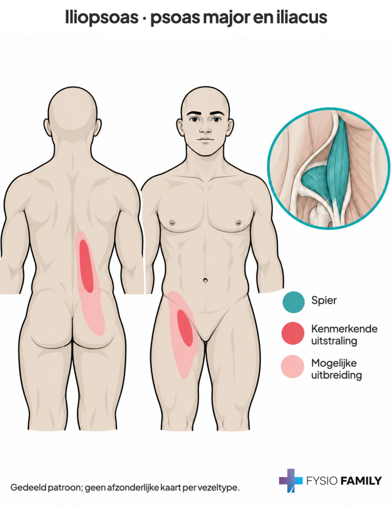 Iliopsoas: lage rug en lies/proximaal voorbeen als gedeelde pijngebieden.