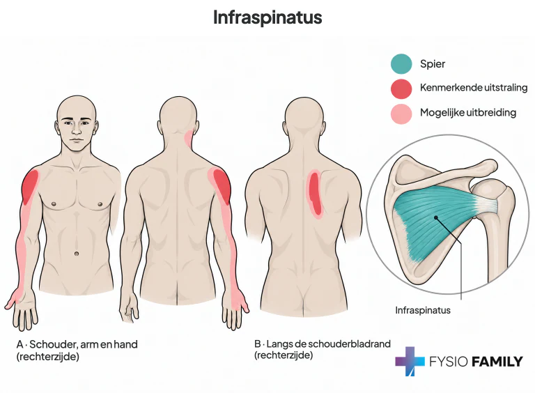 Infraspinatus: herkenbare schouderpijn met mogelijke arm- en handuitstraling; apart patroon langs het schouderblad. De onderdoornspier is in teal zichtbaar.