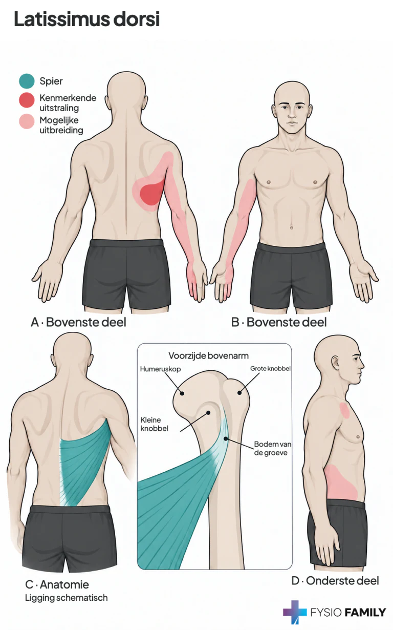 Figure 24.2. Referred pain patterns (essential portion is solid red, spillover portion is stippled red) referred from TrPs in the right latissimus dorsi muscle. A. Back view of the pain pattern from TrPs in their most common location within the axillary portion of the muscle. B. Front view of the same. C. Right latissimus dorsi muscle and attachments. D. Pain pattern of TrPs in the inferior portion of the muscle, which may also refer pain down the arm.