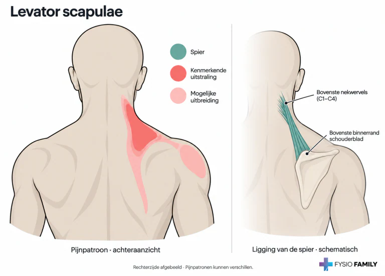 Levator scapulae: kenmerkende pijn in de nek-schouderhoek, met mogelijke uitbreiding langs de binnenrand van het schouderblad en naar de achterzijde van de schouder. Rechts afgebeeld; het aparte spieraanzicht laat de ligging schematisch zien.