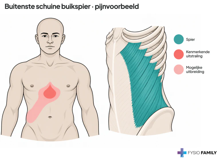 Figuur 49.6A. Bovenbuikverwijzing van de externe schuine buikspier.