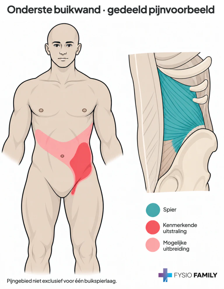 Gedeeld pijnvoorbeeld van de onderste buikwand: onderbuik en lies, met mogelijke uitbreiding. Dit patroon is niet exclusief voor de obliquus internus; de inzet toont diens regionale anatomie.