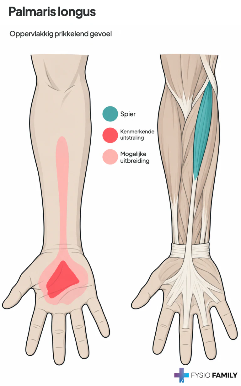 Figure 37.2. Patterns of the referred prickling sensation (dark red) arising from TrPs in a right palmaris longus muscle (light red) in its usual configuration. The referred sensation is described as a superficial painful prickle, rather than an aching pain. The belly of this variable muscle, and therefore its TrPs, may lie high or low in the forearm.