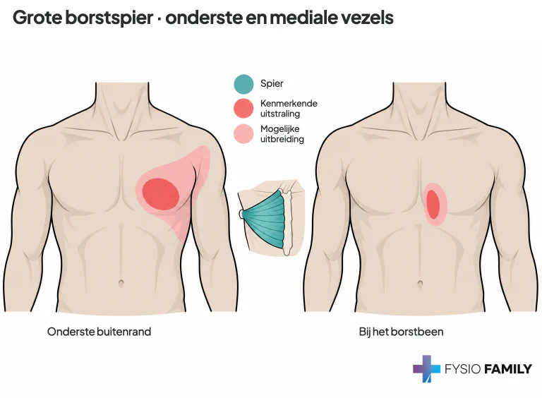 Pectoralis major: onderste buitenrand en mediale borstregio.