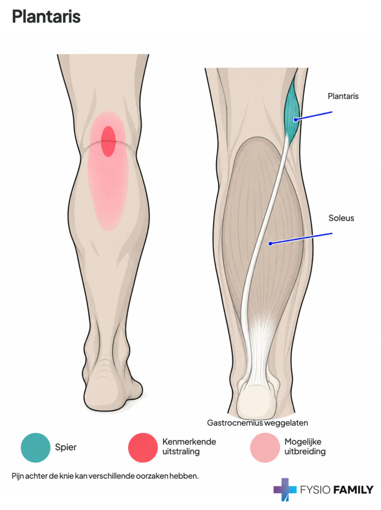 Plantaris: centraal achter de knie, met mogelijke uitbreiding naar de bovenste en middelste kuit.