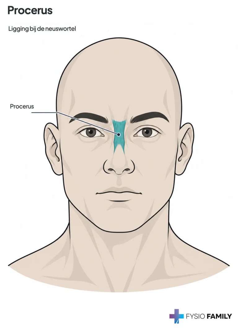 Eigen schematische illustratie van de procerus bij de neuswortel, op basis van de anatomiebeschrijving in hoofdstuk 13. De afbeelding toont de spierligging; het hoofdstuk geeft geen aparte pijnkaart voor deze spier.