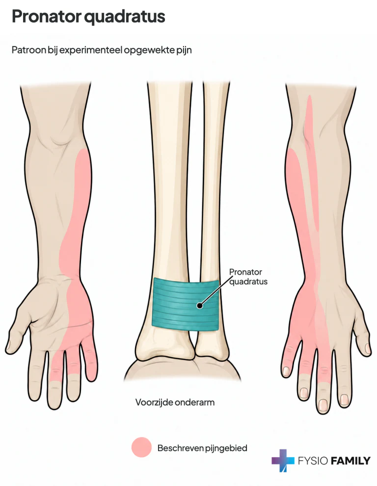 Figuur 38.2E — pronator quadratus. Het afgebeelde uitstralingspatroon is gebaseerd op experimenteel opgewekte pijn.