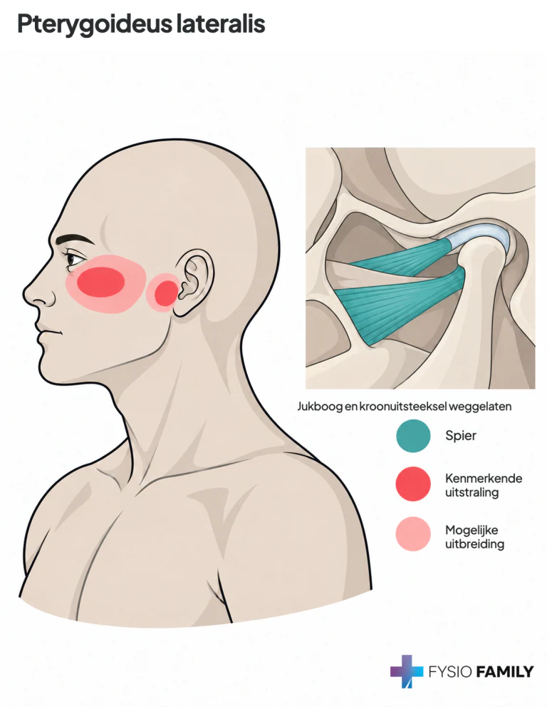 Laterale pterygoideus: beschreven pijn rond de kaakgewrichts- en wangregio. De inzet toont twee spierkoppen bij de condylushals en de gewrichtsdiscus; jukboog en kroonuitsteeksel zijn weggelaten.