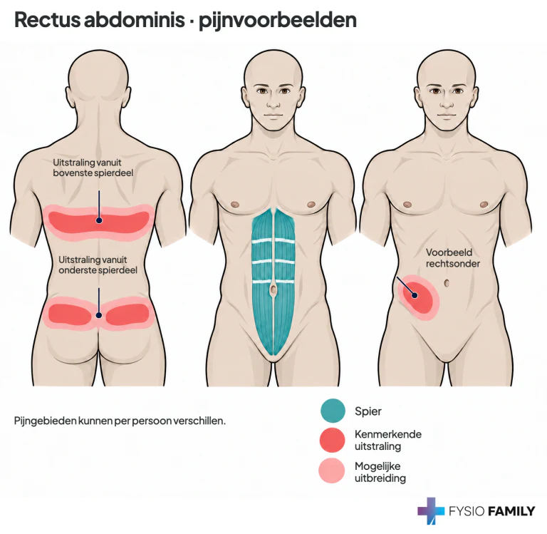 Figuur 49.7A–B. Rug- en onderbuikverwijzing uit verschillende rectus-abdominisgebieden.