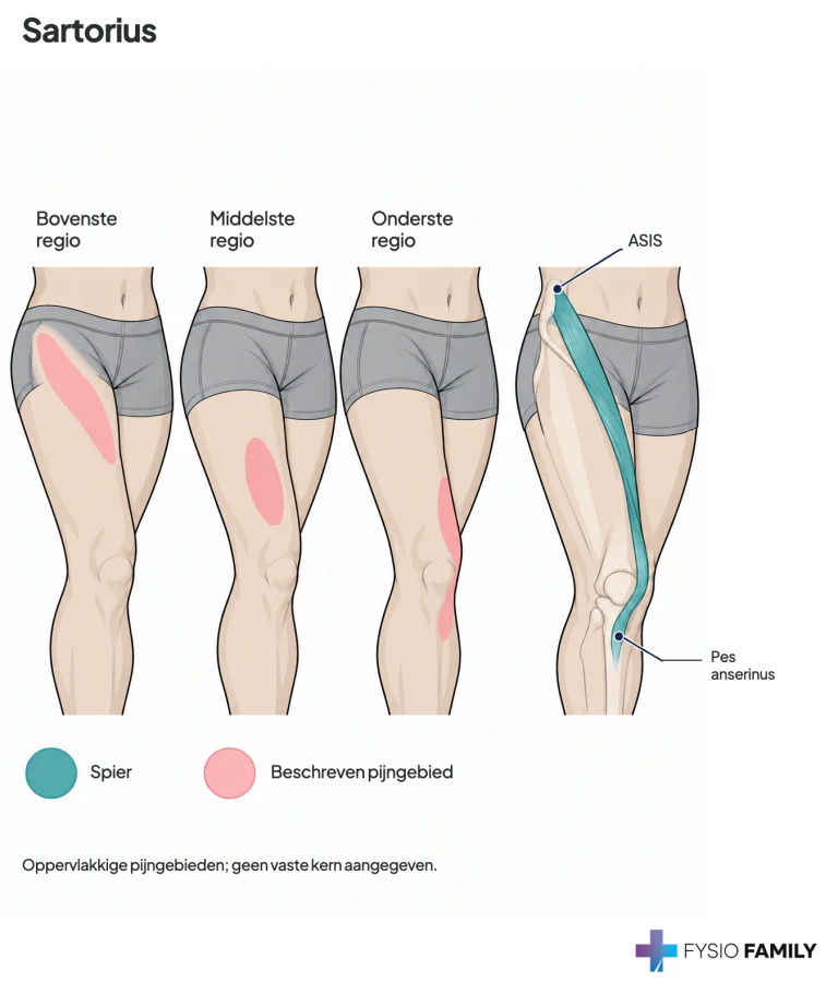 Sartorius: drie mogelijke oppervlakkige pijngebieden langs de spier; de anatomie toont de diagonale band naar de binnenzijde van het scheenbeen.