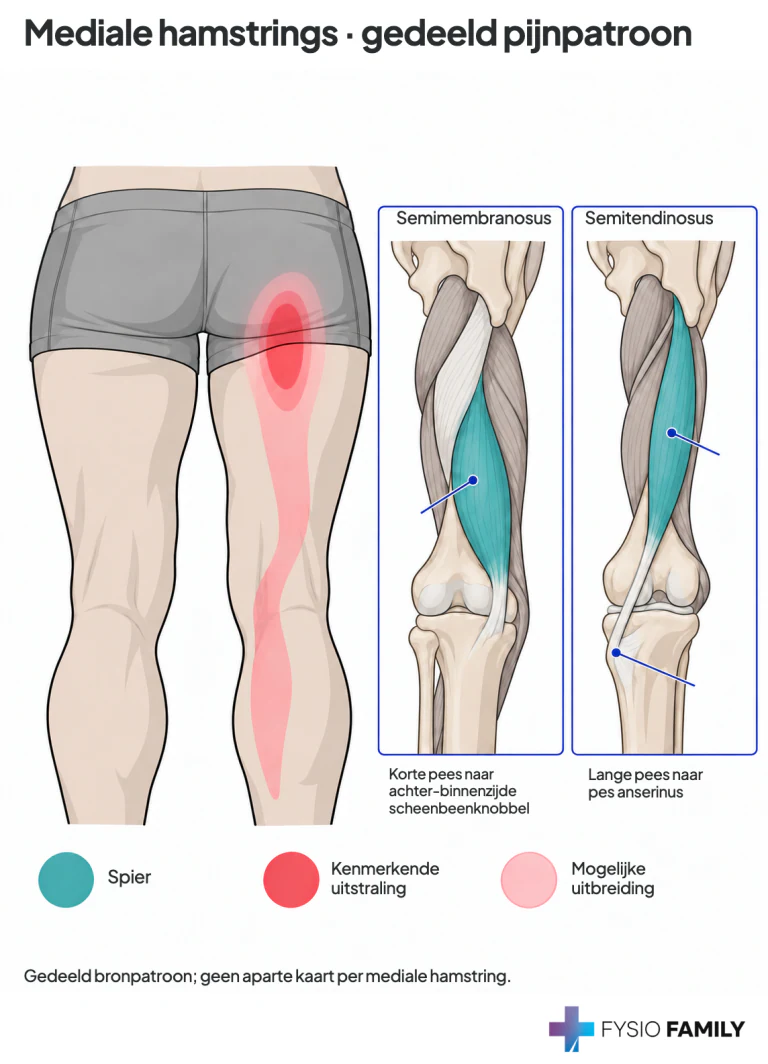 Gedeeld pijnpatroon van de mediale hamstrings: hoog achter-binnenste bovenbeen, met mogelijke uitbreiding langs binnenknie en kuit. De inzetten tonen het verschil tussen de korte insertie van semimembranosus en de lange pees van semitendinosus naar de pes anserinus.