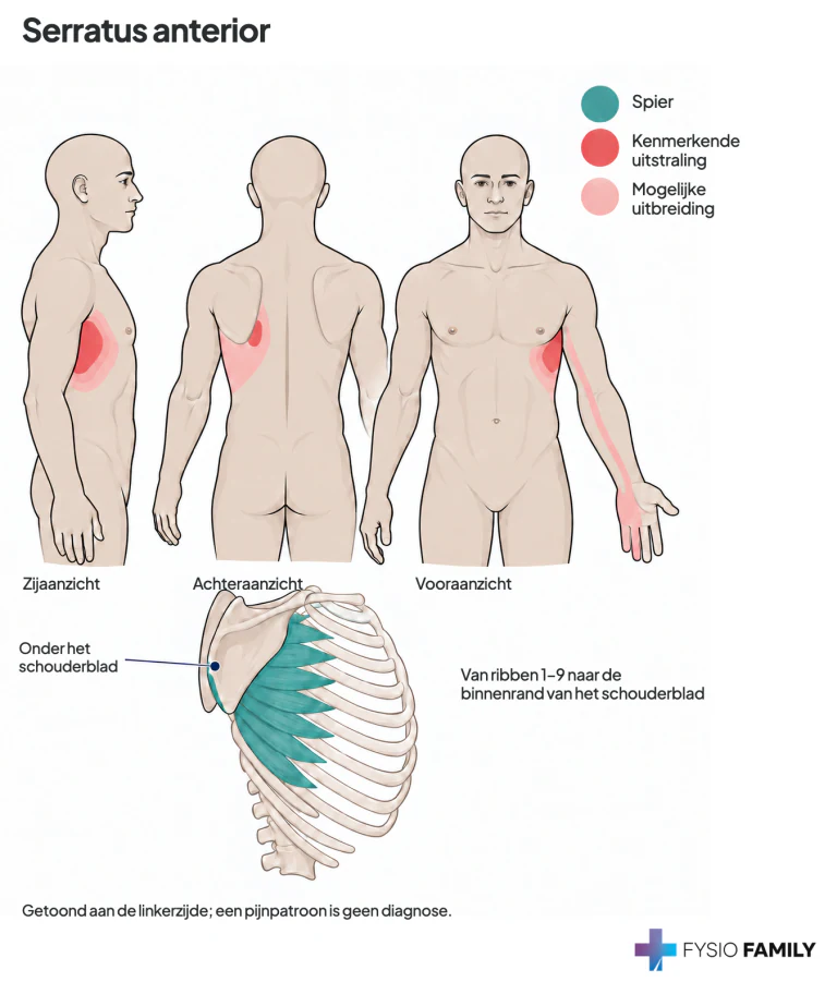 Serratus anterior: anterolaterale borst- en schouderbladuitstraling met mogelijke uitbreiding langs de binnenarm naar palm en ringvinger. Hier aan de linkerzijde getoond. Inzet: ribben 1–9 naar de mediale voorzijde van het schouderblad. Een patroon is geen diagnose.