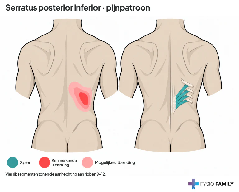Figuur 47.5. Het afzonderlijke flankpatroon van serratus posterior inferior.