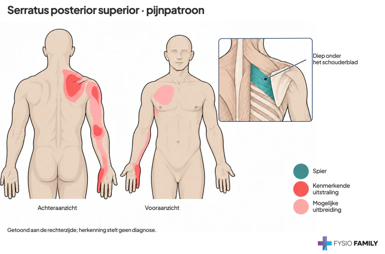 Figuur 47.4. Het schouderblad-, arm- en borstpatroon van serratus posterior superior.