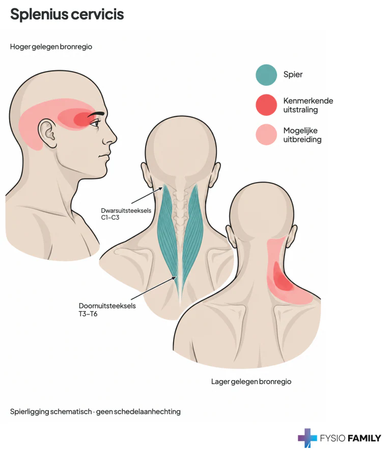 De splenius cervicis loopt van T3–T6 schuin omhoog naar de dwarsuitsteeksels van C1–C3, zonder aanhechting aan de schedel. De kaart onderscheidt het hogere patroon richting oog/achterhoofd en het lagere patroon aan de nekbasis. De centrale tekening is een schema van de ligging.