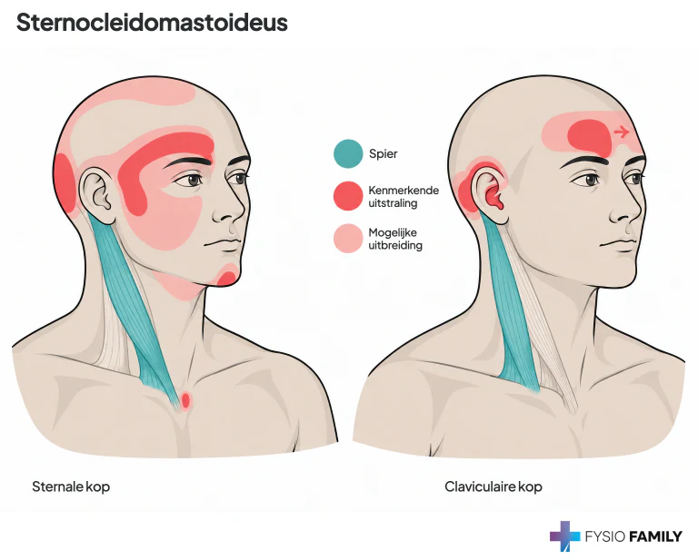 De sternale en claviculaire kop hebben verschillende beschreven uitstralingsgebieden. Keeluitbreiding ligt hoog onder de kaak; uitbreiding naar de andere voorhoofdshelft is lichtroze. Kleurgebieden zijn herkenningsvoorbeelden en geen diagnostische grenzen.