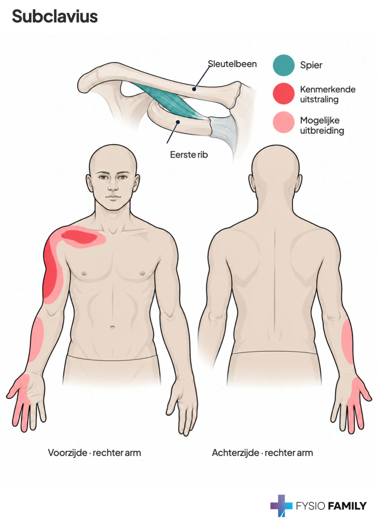Figure 42.5. Subclavius muscle. A. Attachments of the muscle (medium red). B. Referred pain pattern (dark red) of a subclavius TrP. Stippled red is possible spillover in the lateral aspect of the hand.