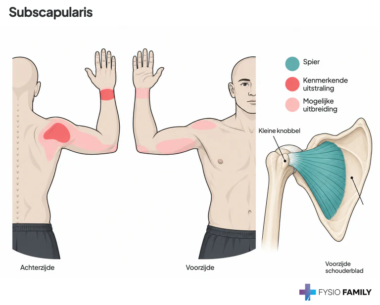 Figure 26.2. Referred pain pattern from TrPs in the right subscapularis muscle. The essential referred pain zone is solid red; the spillover zone is stippled red. Portions of the second through the fifth ribs have been removed for clarity.