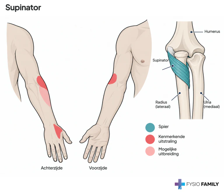 Figure 36.3. Referred pain pattern (dark red) of trigger points in the right supinator muscle.