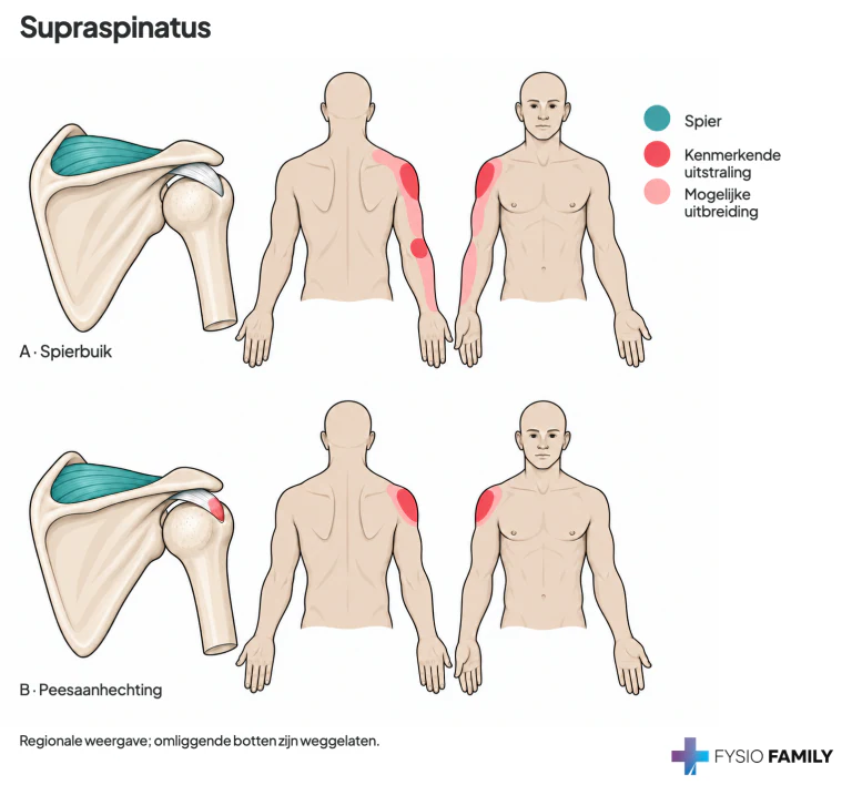 Supraspinatus: A toont de beschreven verwijzing vanuit de spierbuik; B het meer lokale pijngebied bij de peesaanhechting. De inzetten tonen schouderblad en bovenarm met de pees onder het acromion; omliggende botten zijn weggelaten.
