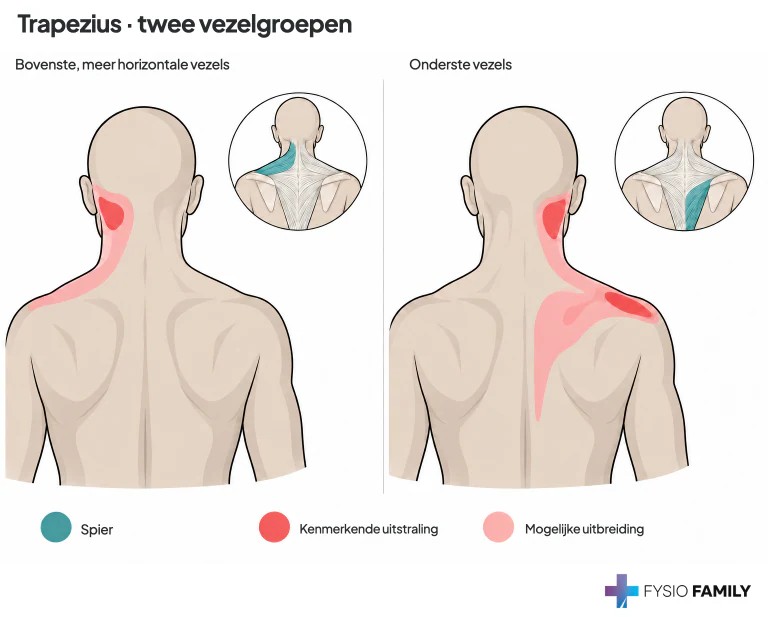 Figuur 6.5. Links in de afbeelding: pijnpatroon van de achterste, meer horizontale bovenste trapeziusvezels. Rechts: pijnpatroon van de onderste trapezius.