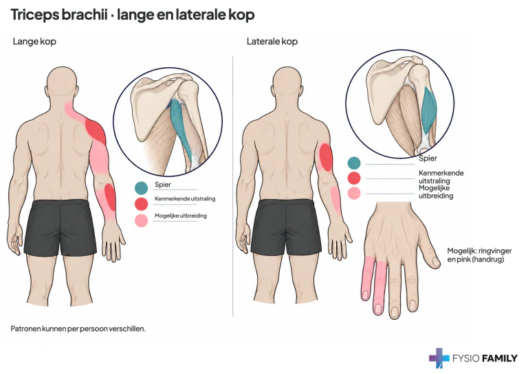 Lange en laterale kop van triceps: overlappende pijnpatronen.