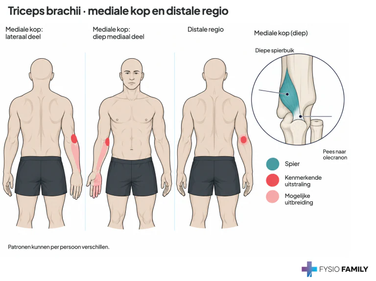 Diepe mediale kop en distale tricepsregio: pijnpatronen.