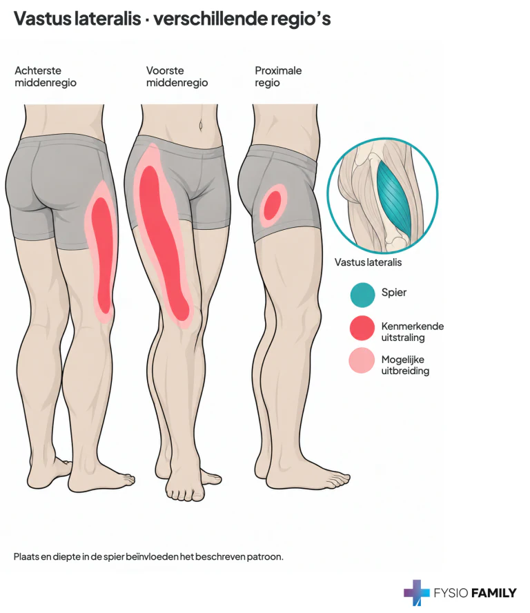 Vastus lateralis: achterste middenregio richting buitenste knieholte, voorste middenregio langs de voor-buitenzijde en een plaatselijk proximaal patroon.