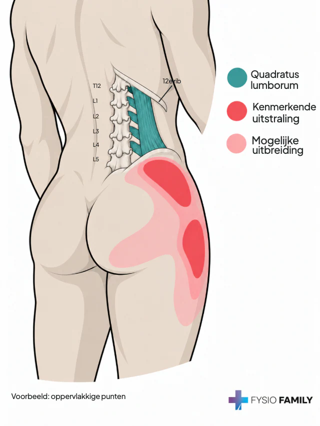 Diepe quadratus lumborum tussen onderste rib en bekkenrand, met kenmerkende pijngebieden rond de bekkenrand en buitenzijde van de heup.