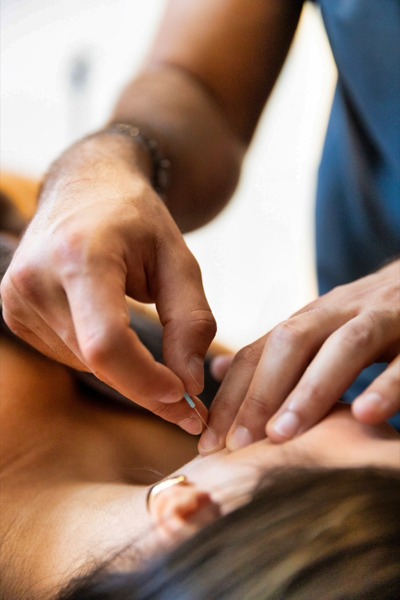 Dry needling masseter