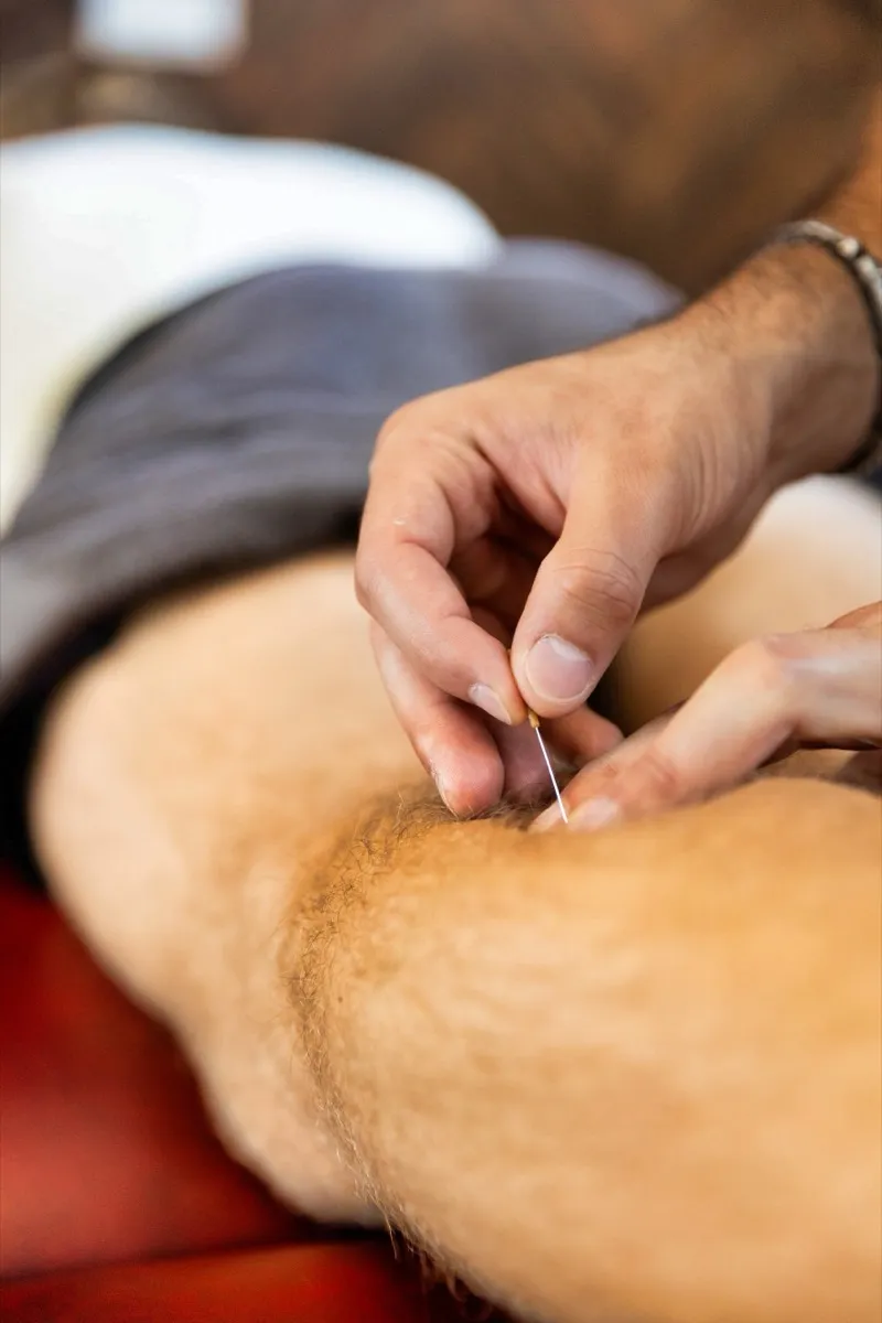 Dry needling gastrocnemius