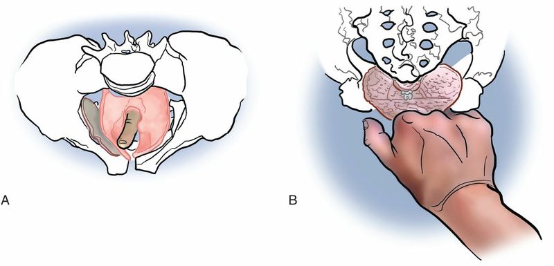 Bekkenbodemspieren - Afbeelding 5