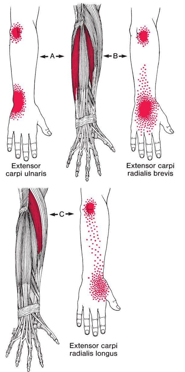 Brachioradialis - Afbeelding 4