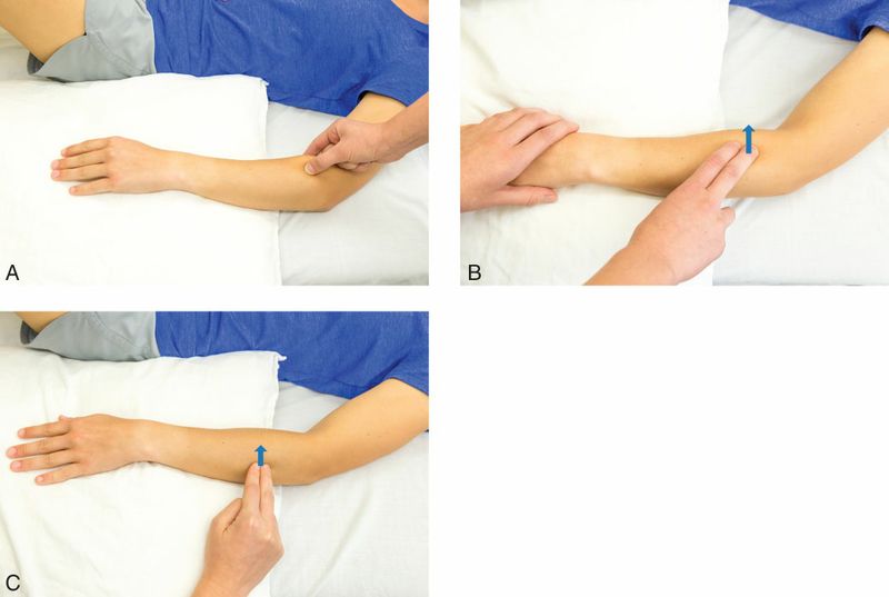 Brachioradialis - Afbeelding 6