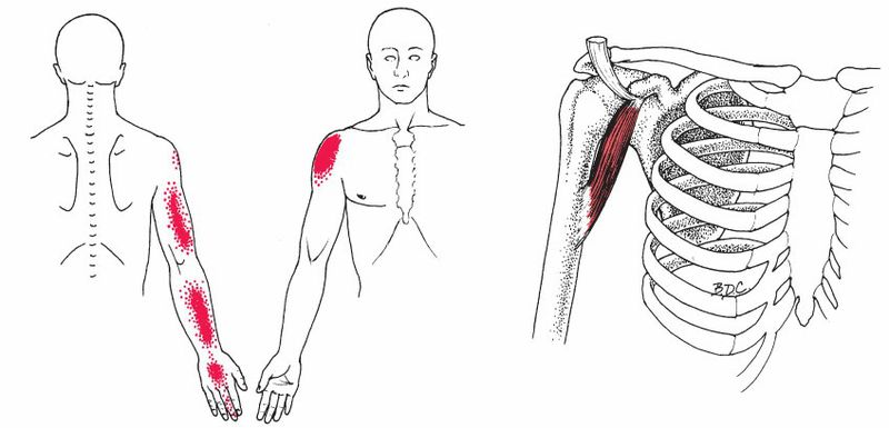 Coracobrachialis - Afbeelding 2
