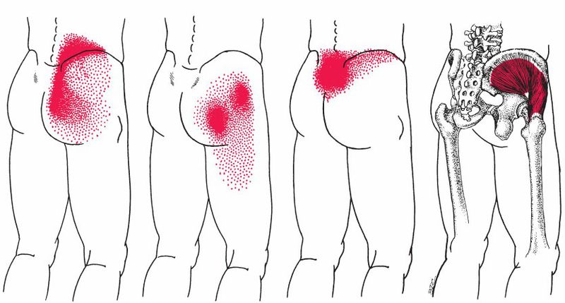 Gluteus Medius - Afbeelding 2