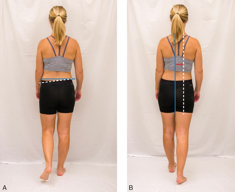 Gluteus Medius - Afbeelding 4