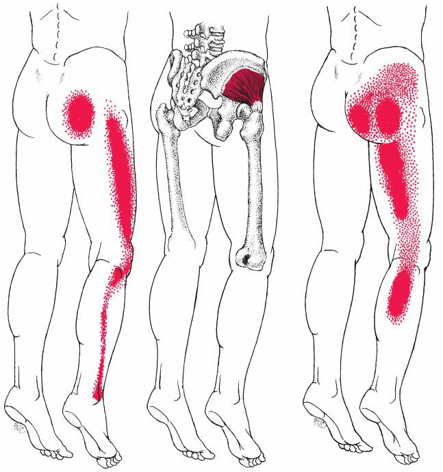 Gluteus Minimus - Afbeelding 4